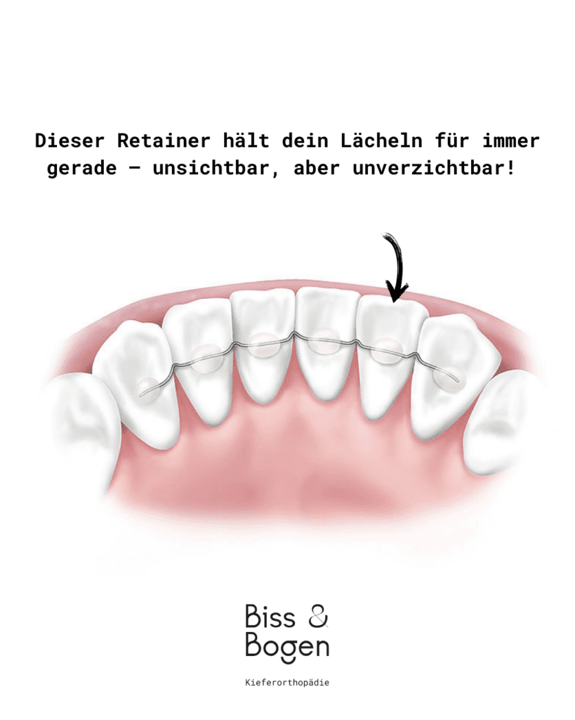 Illustration eines festen Retainers an der Innenseite der unteren Schneidezähne – hält die Zähne nach der kieferorthopädischen Behandlung dauerhaft in Position.